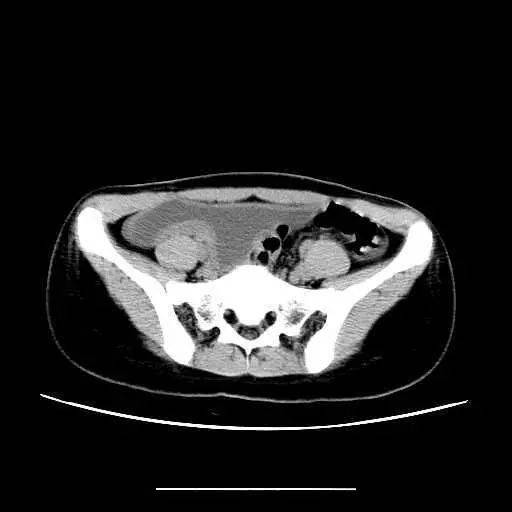 腹腔积液ct图片