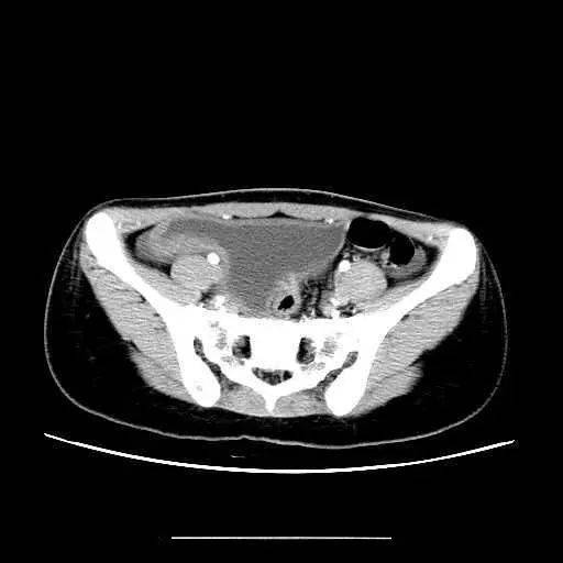 腹腔积液ct图片