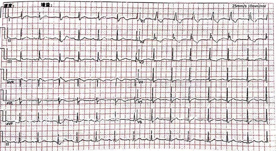 手把手教你讀心電圖危急值之長rr間期李劍專欄第二期