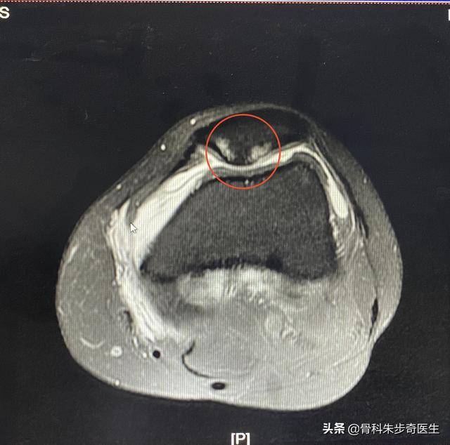 体,磁共振结果出来了,结果如下:首先需要说明的是,患者在疼痛的急性期