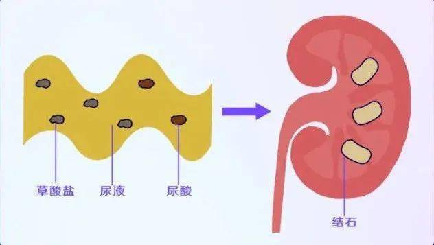 什么|肾结石是什么？如果得了该怎么办？能自己排出去吗？一文告诉你！