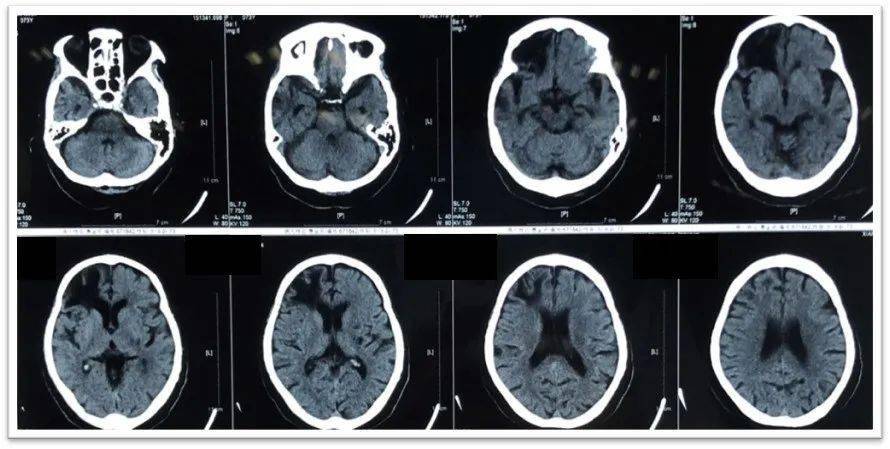图1:1月前头颅ct提示右侧额叶软化灶形成,多发腔隙性脑梗死,脑萎缩.