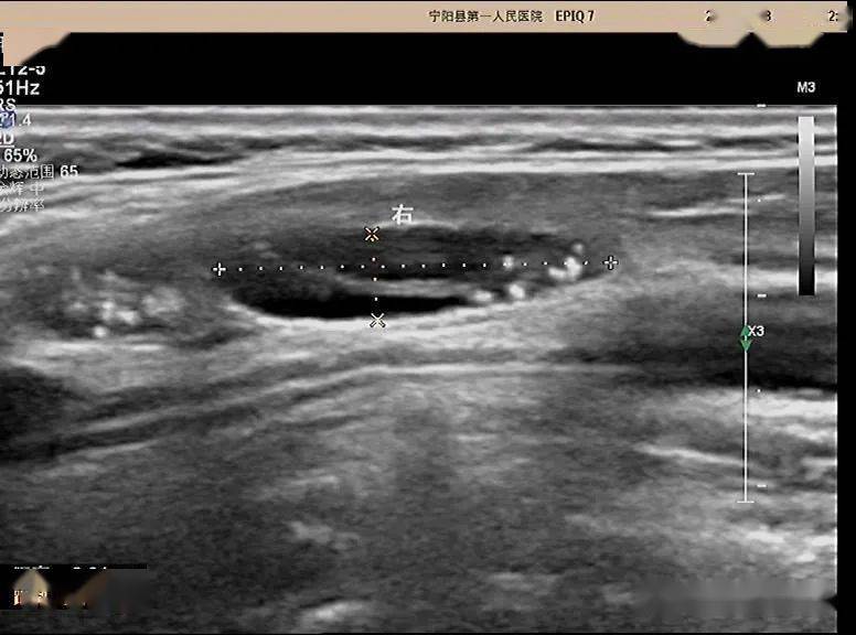 超声问答61这个颈部淋巴结应该如何考虑?