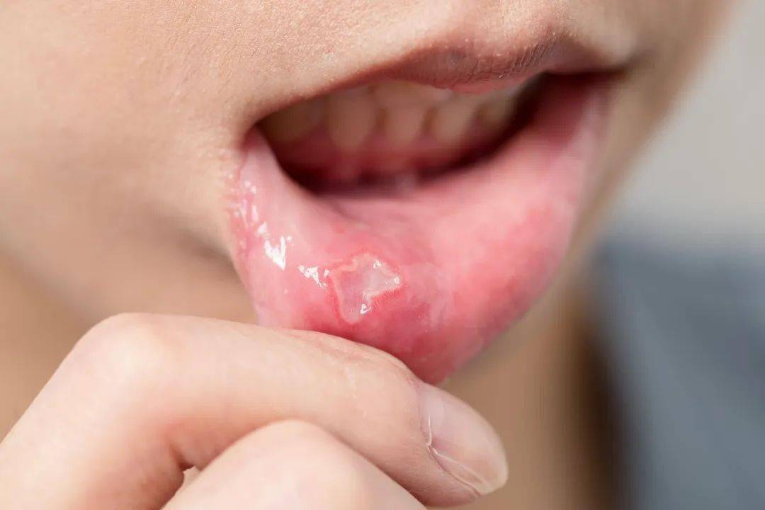 疼疼疼！嘴里长溃疡，怎么做能好得快？
