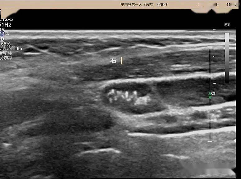 超声问答61这个颈部淋巴结应该如何考虑?