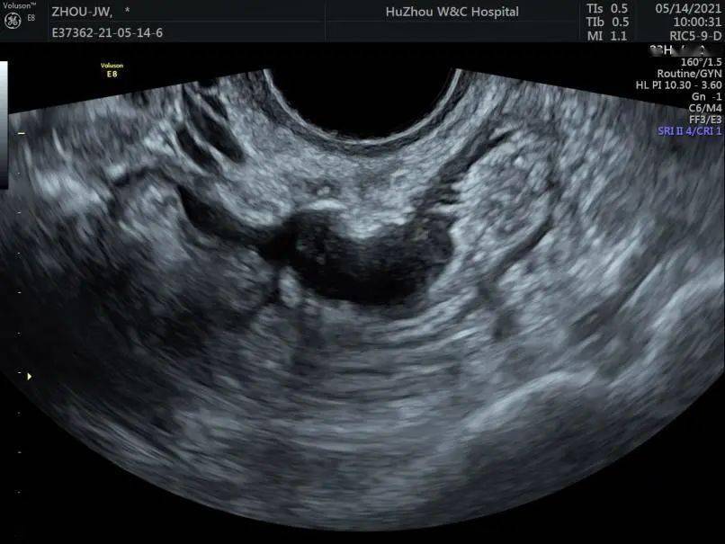 子宫内膜b超图片图片
