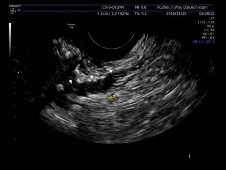 子宫内膜b超图片图片