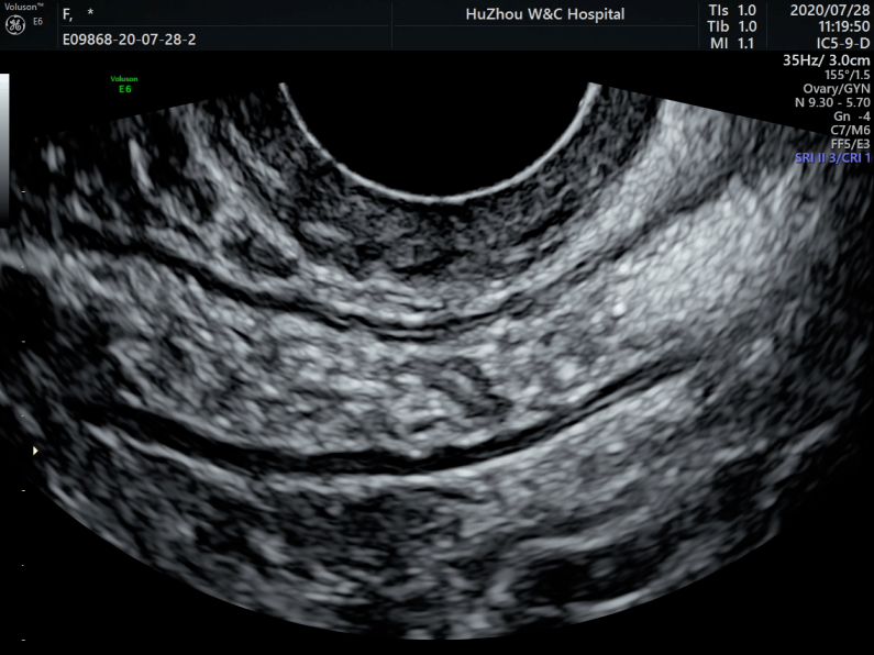 肠道子宫内膜异位症的超声诊断