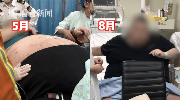 多少斤可以切胃减重 d95ddbf1273d4a8eb40c1d914af89b95.png