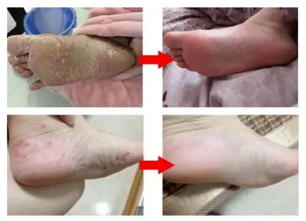 苗方脚气偏方,植物本草深层抑菌_真菌_鞋子_皮肤