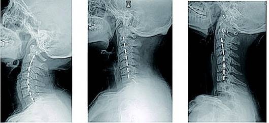 平山病和渐冻症的区别