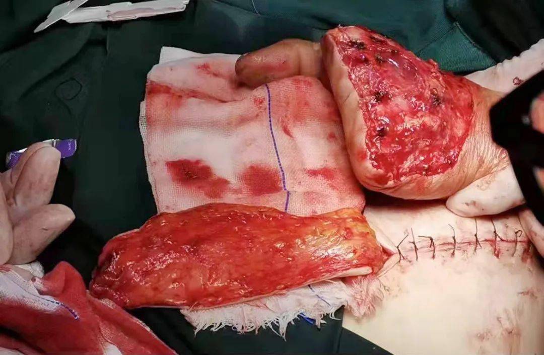 寿阳:剥皮机吃人手!