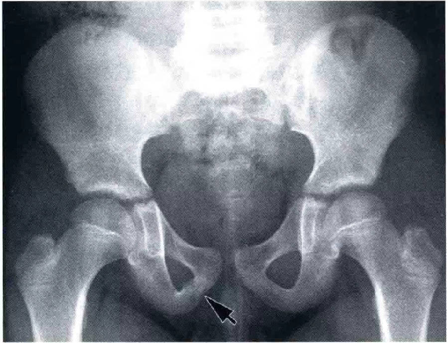 易误诊的骨盆假性骨折 正常骺线 软骨 耻骨 中心