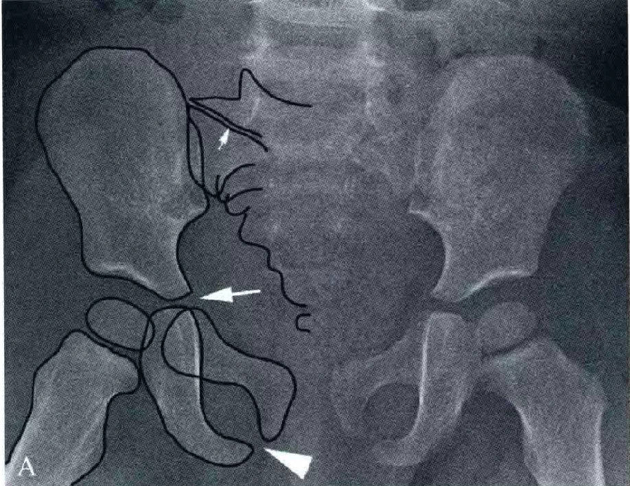 易誤診的骨盆假性骨折:正常骺線_軟骨_恥骨_中心