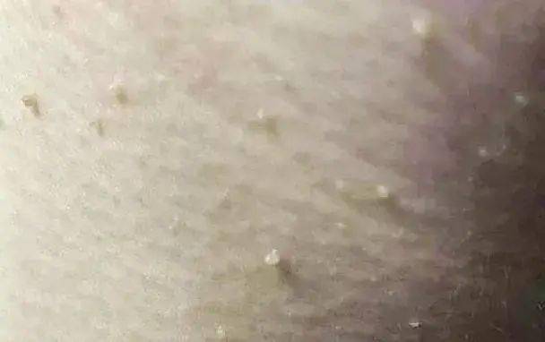 眼睛别再用针挑了！用它，脂肪粒自己“掉”下来，比医美效果还赞！