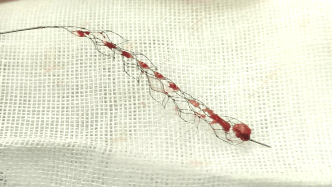 第三代取栓支架定乾坤基底动脉原位狭窄急性闭塞一例