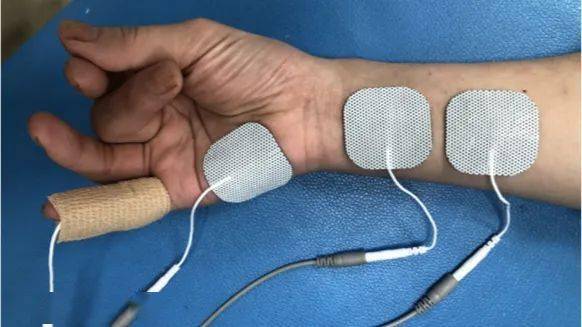 康复医学科手外伤别沮丧康复训练来啦