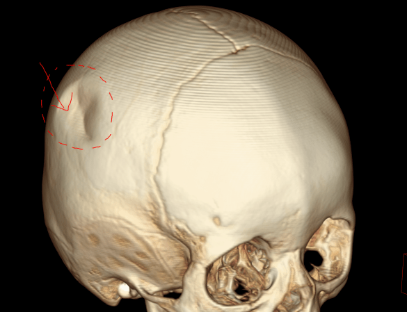 3案例3:一岁孩子摔着头,颅骨凹进去了所幸经过神经外科医生全力抢救