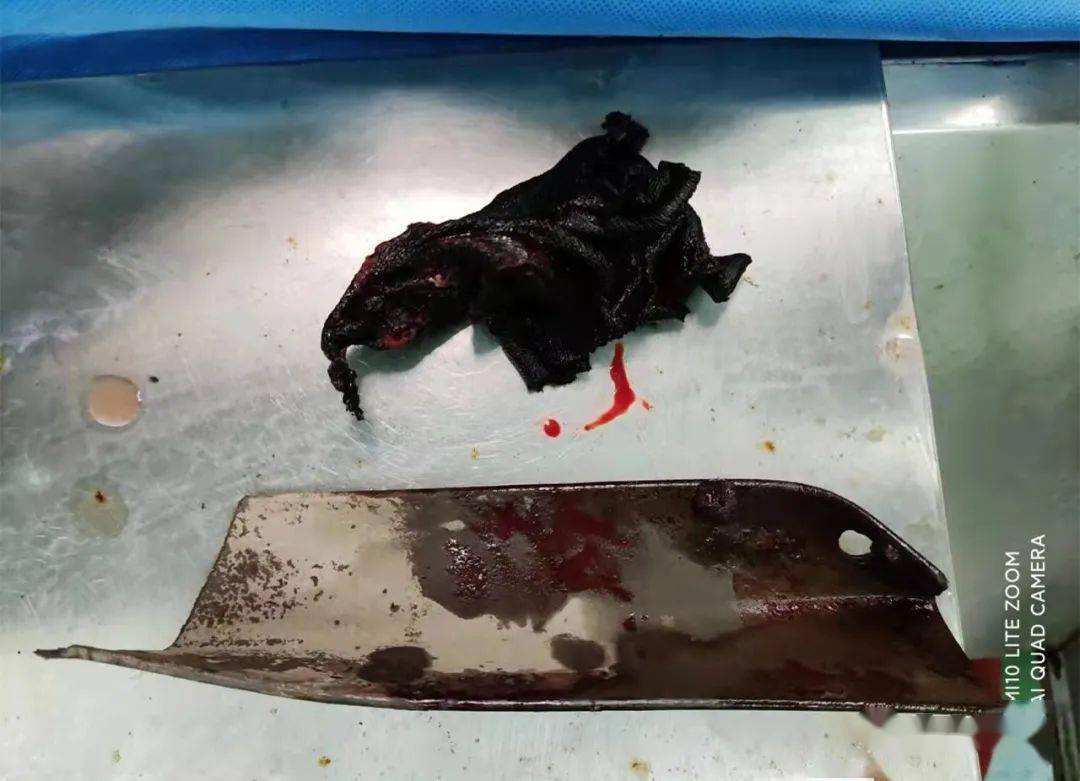 左肱骨开放性骨折并贯穿伤经过检查初步诊断为:急诊科李维凯主任和王