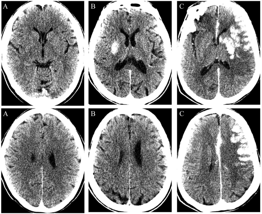 精选编译ct显示脑内高密度可预测ais介入治疗后的恶性脑水肿
