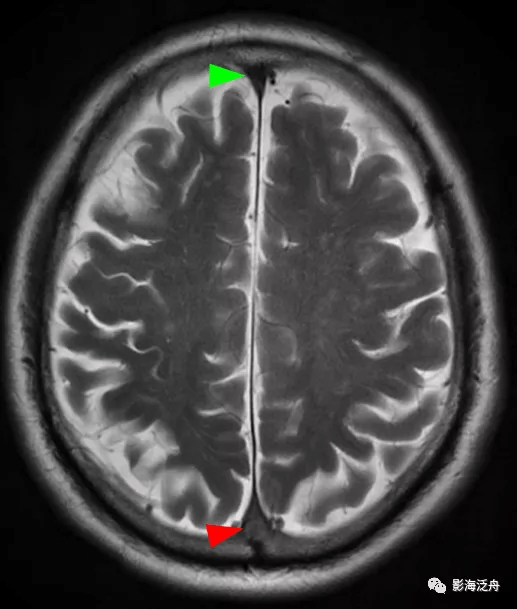 诊断|颅脑MR平扫中极易漏诊的点