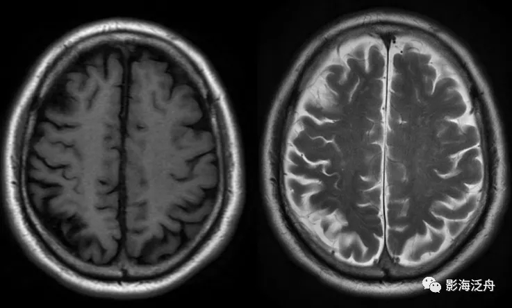 诊断|颅脑MR平扫中极易漏诊的点