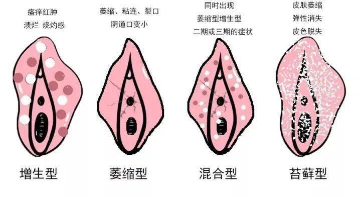 外阴白斑会癌变吗图片