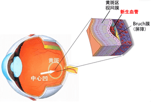 什么是黄斑病的表现 fb287cfc58b546faa3640378097f7fc0.png