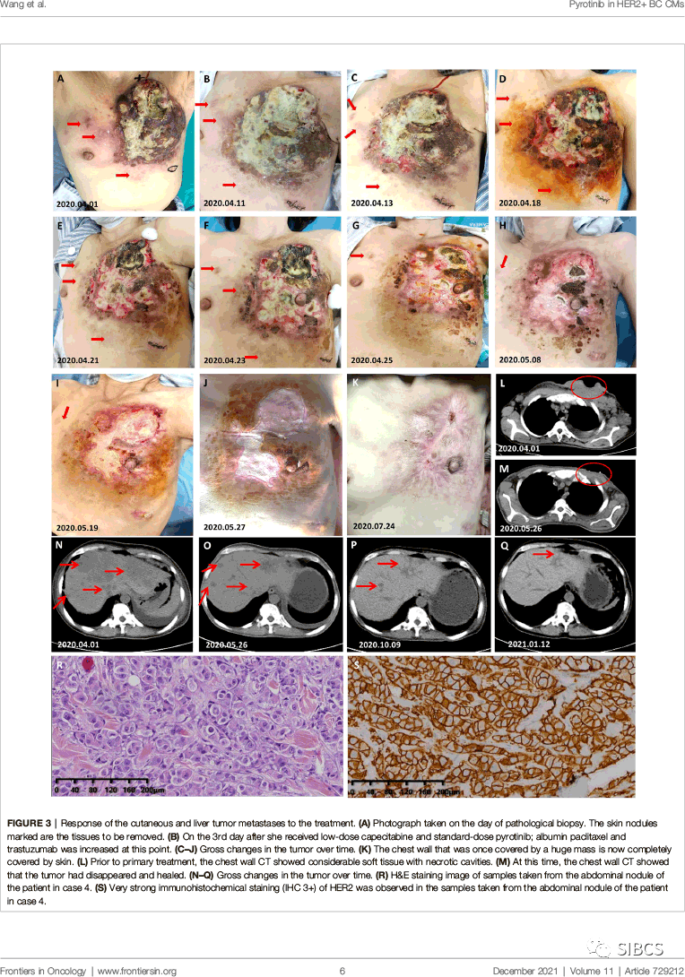 癌细胞转移皮肤图片图片