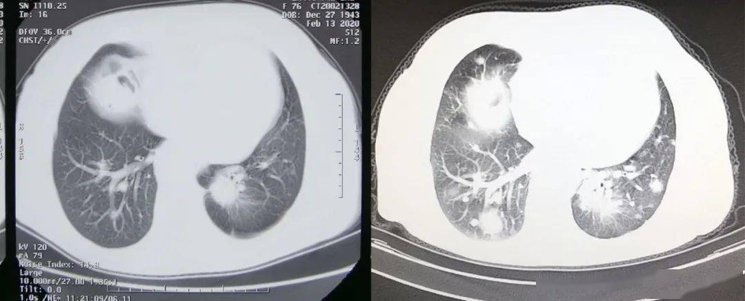 【关注】3年前确诊肺癌晚期,结果……_治疗_肿瘤_奶奶