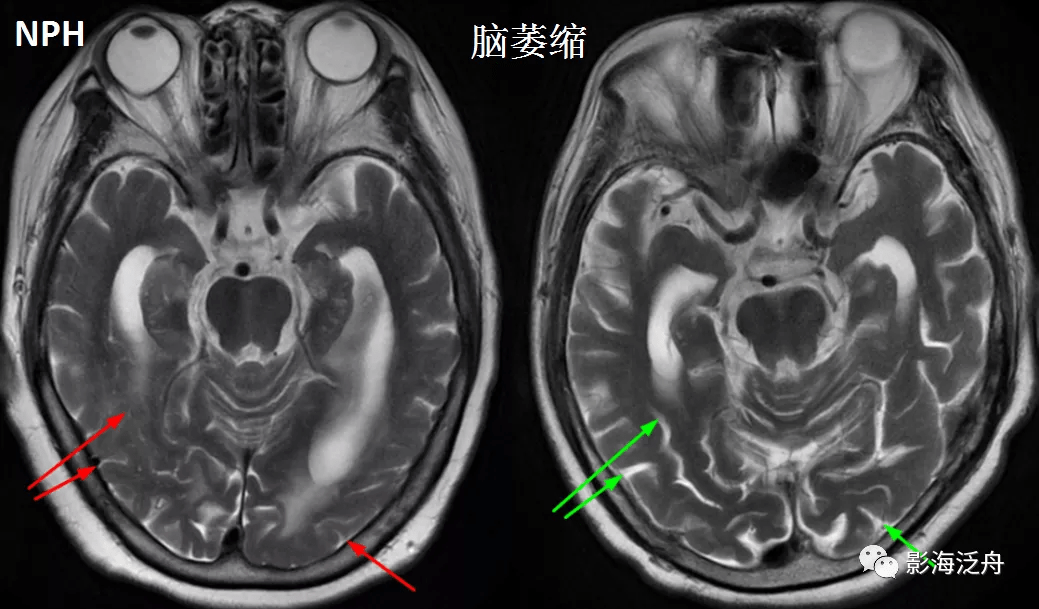 诊断|小心误诊，这可不是单纯的脑萎缩