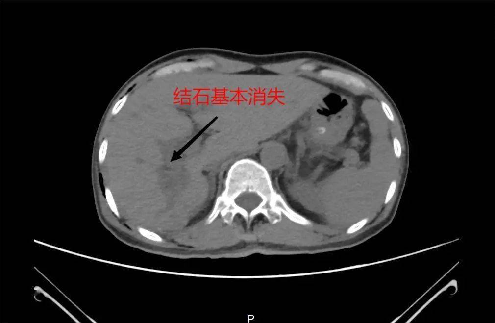 激光|深圳恒生医院利用钬激光碎石术为患者取出数十枚肝内胆管结石
