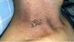 这个病例告诉你!_皮肤_放疗_患者