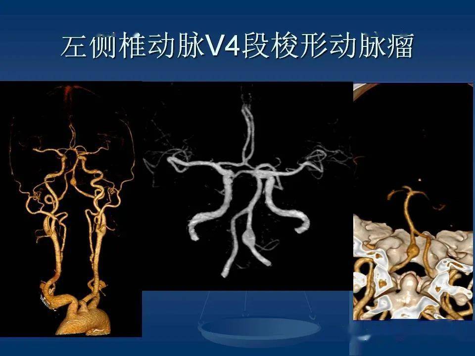 头颈部cta解剖图片图片