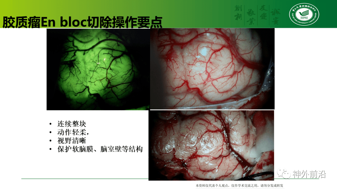 手术前沿 | 中山肿瘤牟永告:胶质瘤"边界" 之我见