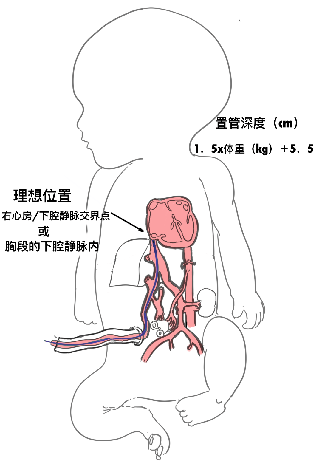 脐静脉导管尖端位置图片