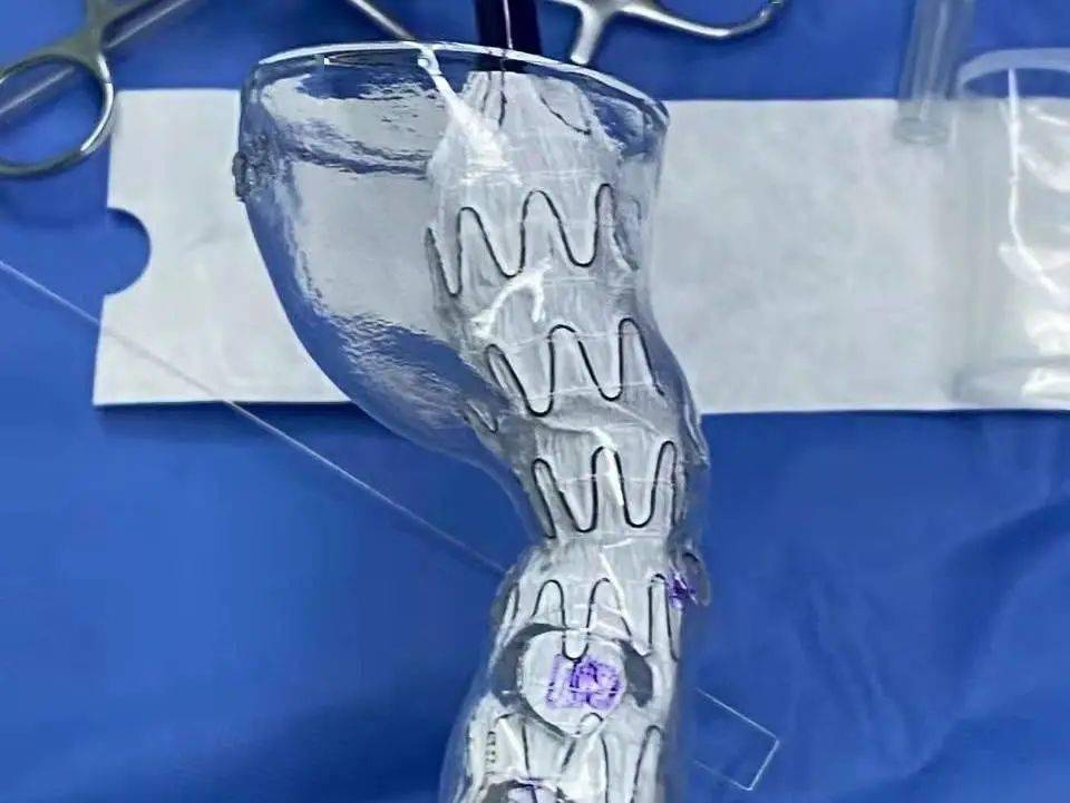 江都人医连续拆除3例复杂腹主动脉瘤炸弹这种血管外科常见疾病请千万