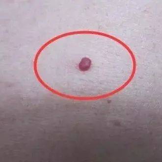血痣,肝胆病变前兆!_方法_经络_大腿
