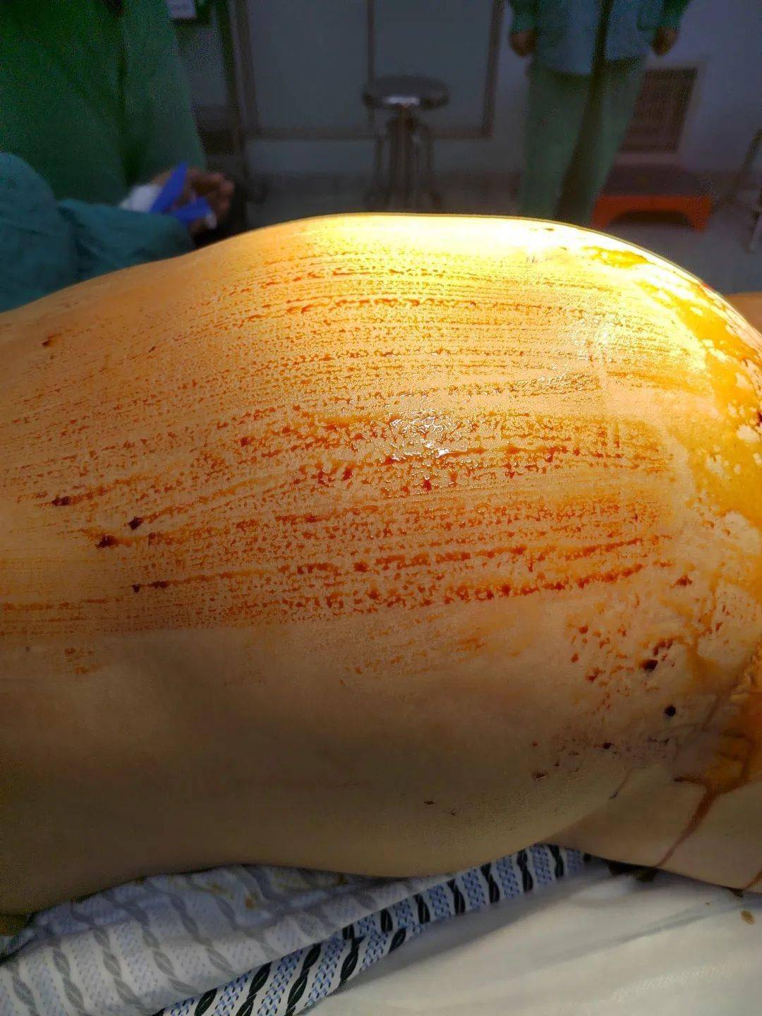 53岁阿姨肚大如怀孕,身体里竟藏着30斤的囊肿……_郭晓丽_手术_市人民