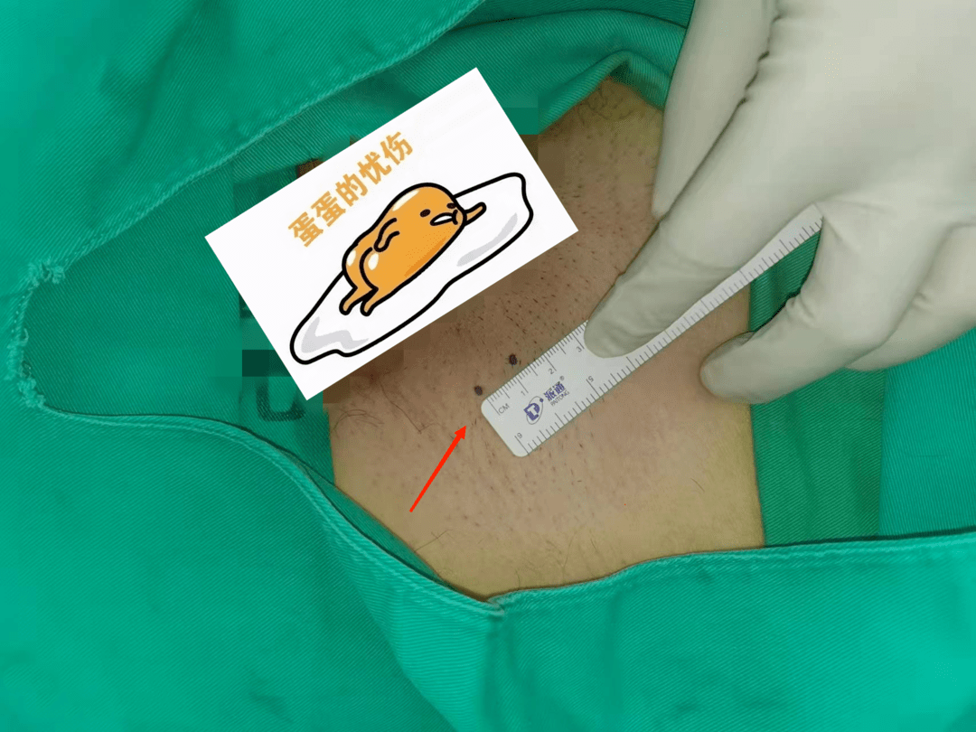 热闻速递精索静脉曲张让人难堪市九院还你爸气十足