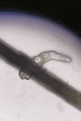 尸体头上抠下来的白泥竟是螨虫尸体!头痒头屑出油多,用它就对了