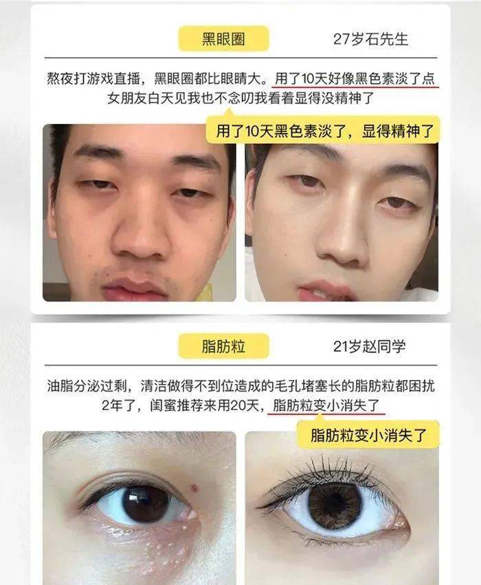 医学长了脂肪粒到底挤不挤?一分钟教你处理它的正确姿势!