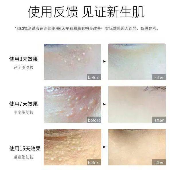 医学长了脂肪粒到底挤不挤?一分钟教你处理它的正确姿势!