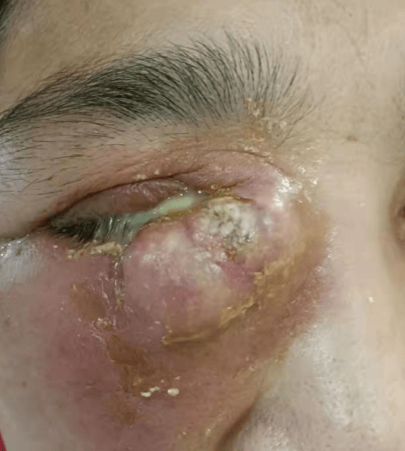 50岁阿姨眼睛肿成馒头急性泪囊炎原来这么可怕