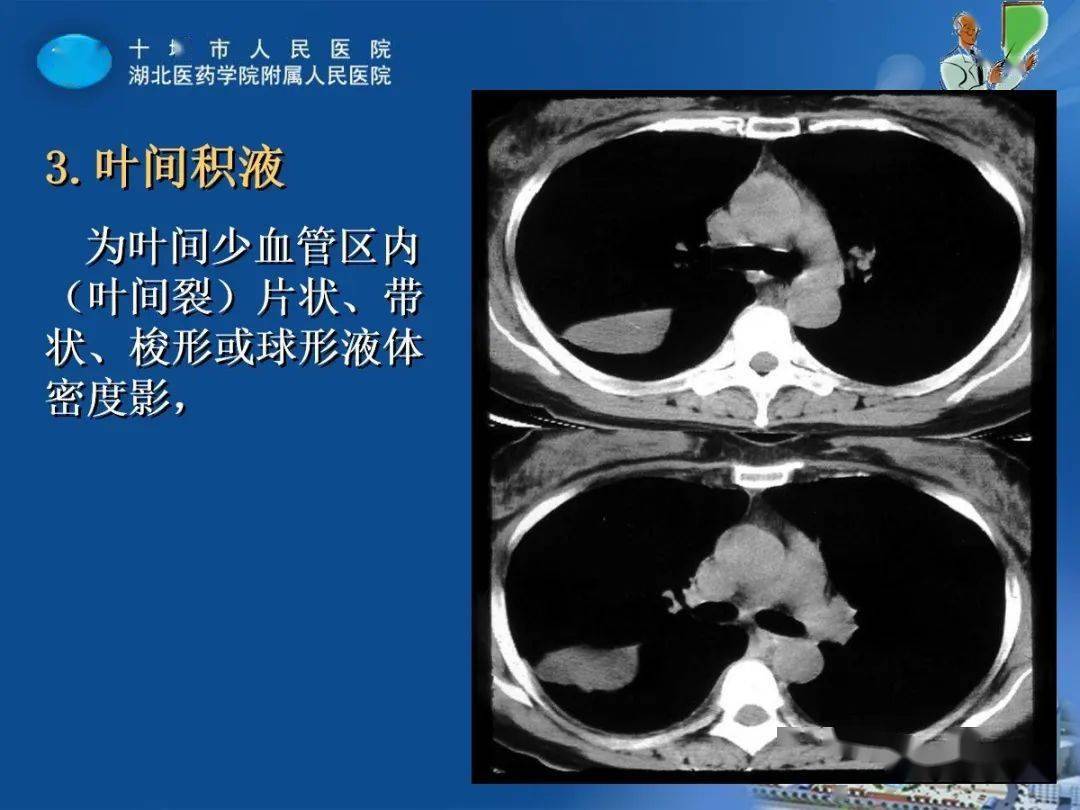 胸膜疾病影像表现