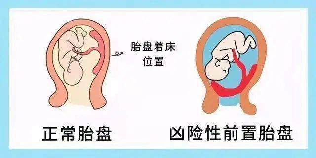 发生植入的危害约50%,风险在于胎盘植入的比较深,胎盘组织植入到浅肌