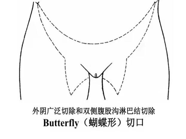 外阴瘙痒一查竟是恶性肿瘤女人有病千万不要委屈自己