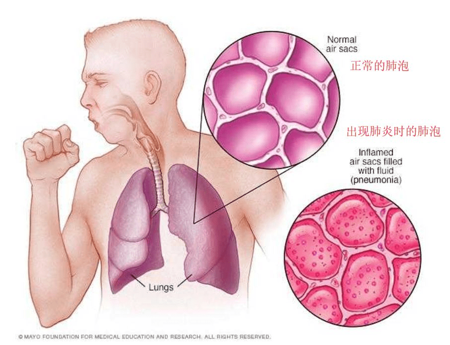 肺泡|为什么小宝宝特别容易得肺炎？