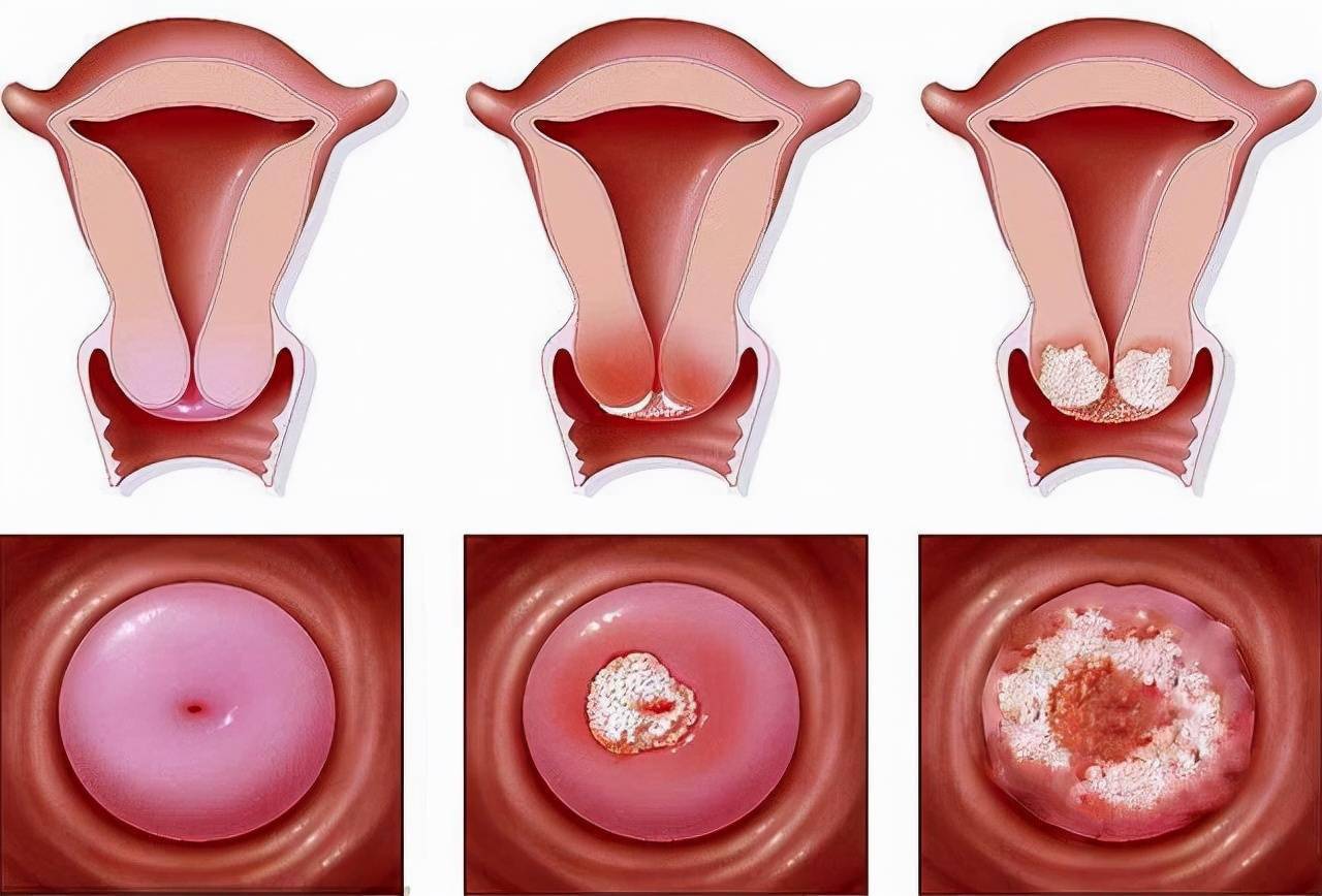 女性宫颈出现病变腿部可能会发出预警不妨留心观察下