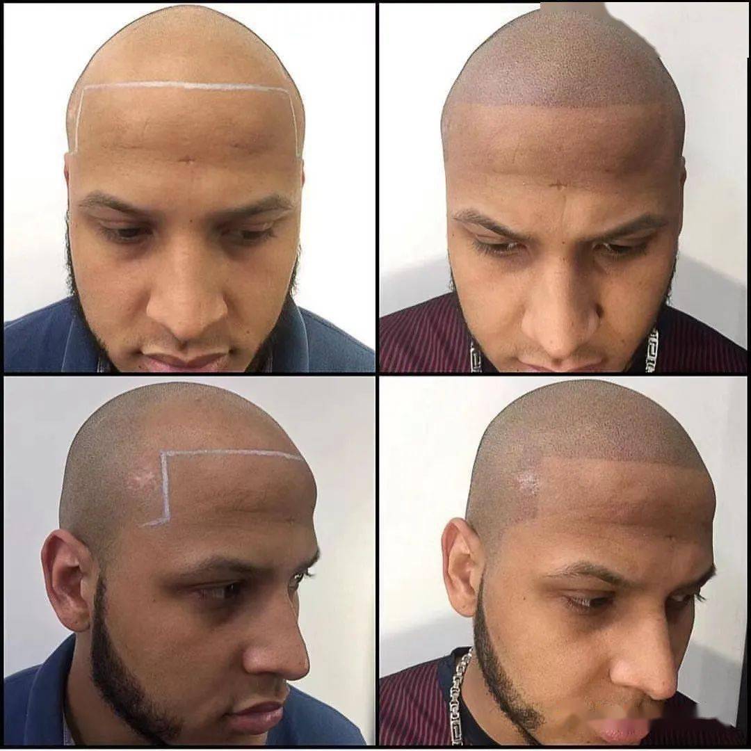 用纹身代替"植发",真的可行吗?_头皮_头发_杨幂